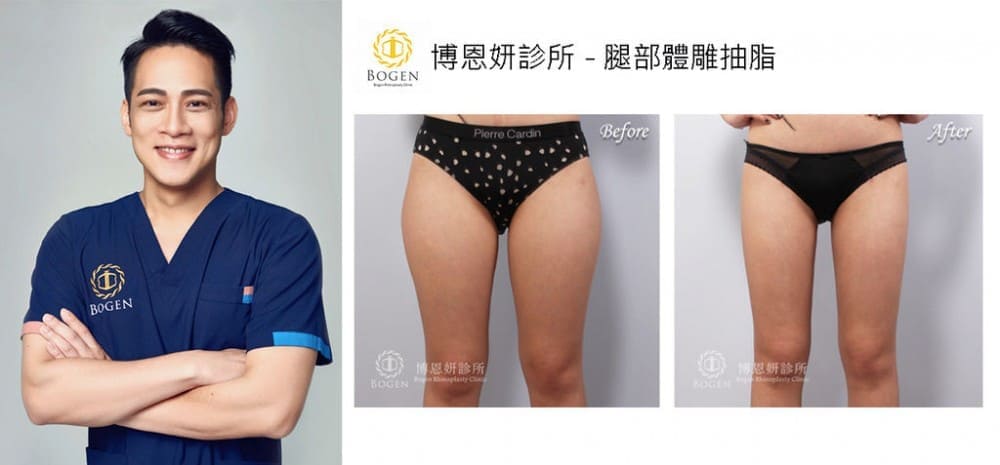 大小腿抽脂,大腿抽脂,小腿抽脂,馬鞍肉抽脂,抽脂手術,李岳樺醫師,博恩妍
